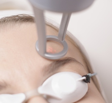 Laser tulowy TU LOVE